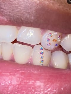 View Teeth Whitening, Cosmetic - Amar Jones, Baltimore, MD