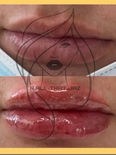 View Lips, Filler, Cosmetic - Jazmine Depew, Carson City, NV