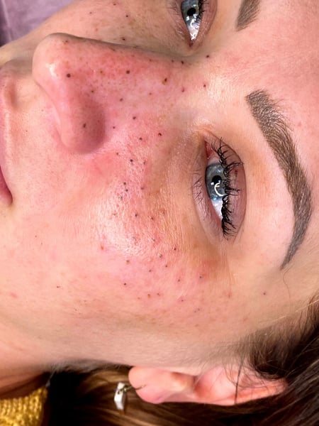 Image of  Freckles, Cosmetic Tattoos, Cosmetic