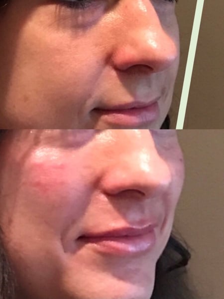 Image of  Cosmetic, Cheeks, Filler