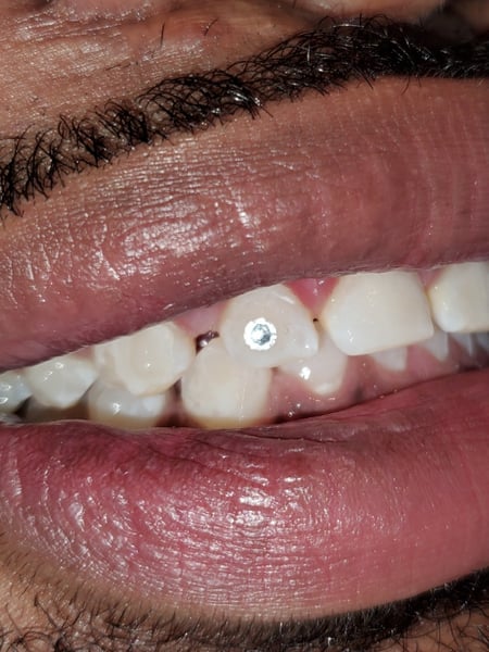 Image of  Cosmetic, Teeth Whitening, Dentistry, Teeth Bleaching