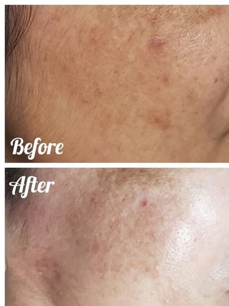 Image of  Skin Treatments, Facial, Chemical Peel, Skin Treatments