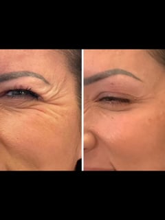View Chin, Minimally Invasive, Neck Tightening, Filler, Lips, Cheeks, Smile Lines, Cosmetic, Skin Treatments, Neurotoxin, Facial, Chemical Peel, Microdermabrasion, Microneedling, LED Acne Therapy, Low-Level Laser Therapy, Forehead, Body Sculpting, Lower Face, Eyes, Upper Face, HydraFacial, PRP Facial, Dermaplaning, Radio Frequency, Skin Treatments, Nose - Jen Phillips-Kiernan, Round Rock, TX