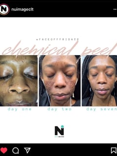 View Cosmetic, Chemical Peel, Skin Treatments - Shaquanna Johnson, Charlotte, NC