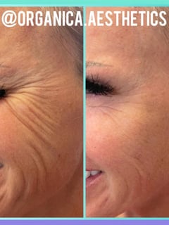 View Forehead, Nose, Chin, Minimally Invasive, Neck Tightening, Filler, Lips, Cheeks, Smile Lines, Cosmetic, Skin Treatments, Neurotoxin, Facial, Chemical Peel, Microdermabrasion, Microneedling, LED Acne Therapy, Dermaplaning, PRP Facial, HydraFacial, Upper Face, Eyes, Lower Face, Body Sculpting, Low-Level Laser Therapy, Radio Frequency, Skin Treatments - Jen Phillips-Kiernan, Round Rock, TX
