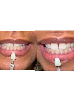 View Cosmetic, Teeth Whitening - Treasure G., Yonkers, NY