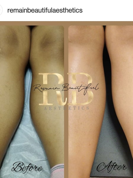 Image of  Legs, Sugaring, Hair Removal