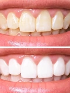 View Cosmetic, Teeth Whitening - MinYoung Jeong, Los Angeles, CA