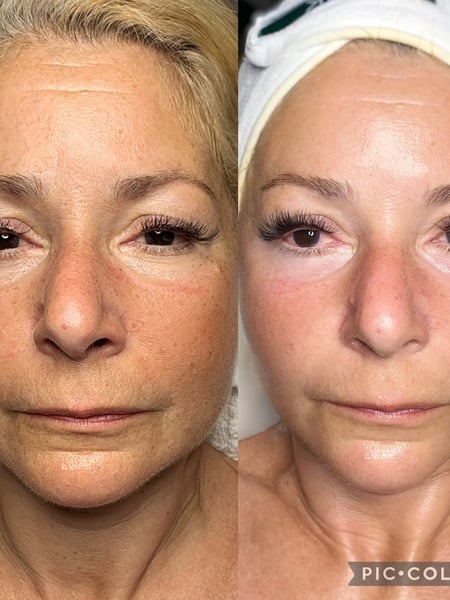 Image of  Cosmetic, Skin Treatments, Facial, Microdermabrasion, Chemical Peel