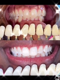 View Teeth Whitening, Cosmetic - Amar Jones, Baltimore, MD
