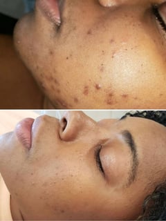 View Cosmetic, Chemical Peel, Microdermabrasion, Facial, Skin - Deborah Agnew, Altamonte Springs, FL