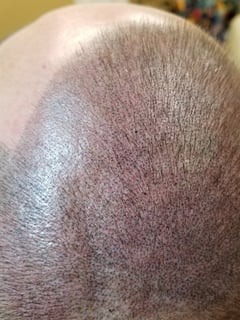 View Cosmetic Tattoos, Scalp Micropigmentation, Cosmetic - Carol Cheshire, Coopersburg, PA