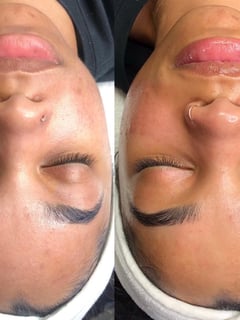 View Facial, Microdermabrasion, Skin Treatments - Meegwun Desjarlait, Golden Valley, MN