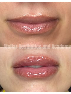 View Cosmetic, Filler, Lips - Ella Yakan, Irvine, CA