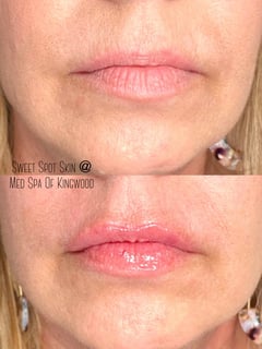 View Filler, Cosmetic, Lips - Jenn Hooker, Kingwood, TX