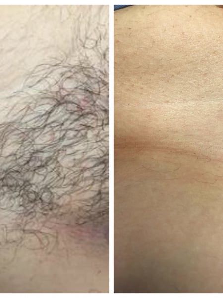 Image of  Hair Removal, Laser Hair Removal, Bikini Area