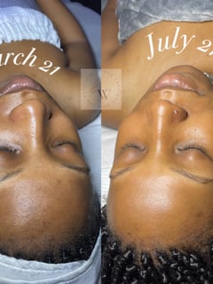 View Cosmetic, Skin Treatments - Ranneisha Johnson, Cedar Hill, TX