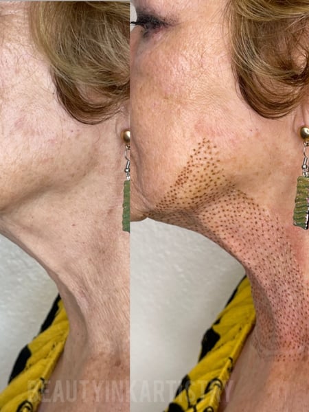 Image of  Cosmetic, Minimally Invasive, Neck Tightening