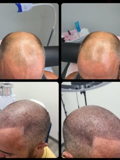 View Men's Hair, Scalp Treatment, Hair Treatments/Restoration, Hair Restoration - Josh Sandoval, West Jordan, UT