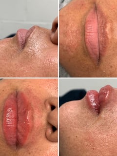 View Filler, Lips, Cosmetic - Nathalie Pebbles Tapia, 