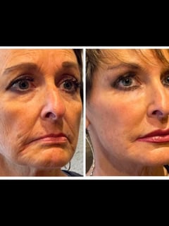 View Neck Tightening, Filler, Lips, Cheeks, Smile Lines, Cosmetic, Skin Treatments, Neurotoxin, Facial, Chemical Peel, Microdermabrasion, Microneedling, LED Acne Therapy, Dermaplaning, PRP Facial, HydraFacial, Upper Face, Eyes, Lower Face, Body Sculpting, Low-Level Laser Therapy, Radio Frequency, Skin Treatments, Forehead, Nose, Chin, Minimally Invasive - Jen Phillips-Kiernan, Round Rock, TX