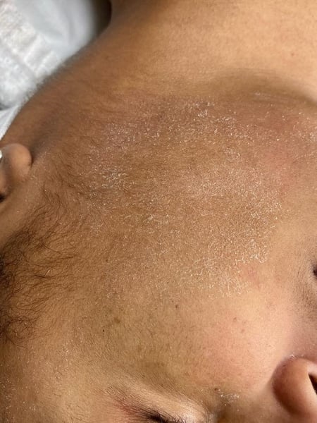 Image of  Microdermabrasion, Skin Treatments