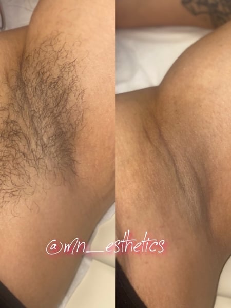 Image of  Cosmetic, Underarms , Waxing