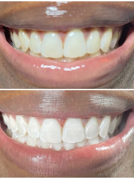 Image of  Teeth Whitening, Cosmetic