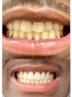 View Teeth Whitening, Cosmetic - Treasure G., Yonkers, NY