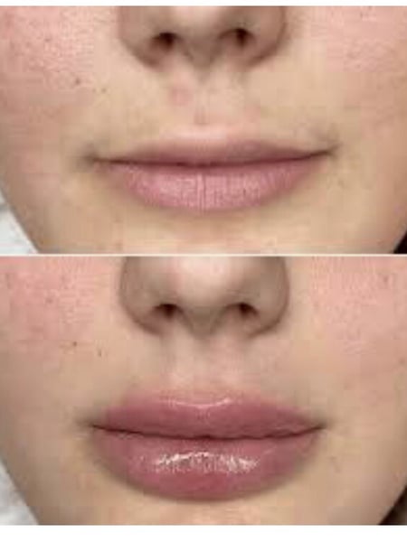 Image of  Cosmetic, Filler, Lips, Nose, Forehead, Cheeks, Chin