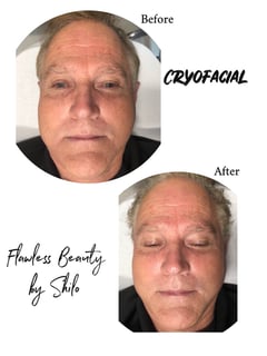 View Cosmetic, Mini Facelift, Minimally Invasive, Facial, Skin Treatments - Shilo Hope Stanley, La Mesa, CA