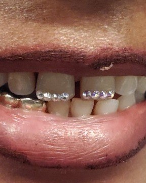 Image of  Cosmetic, Teeth Whitening