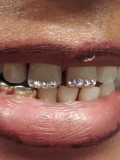 View Cosmetic, Teeth Whitening - Taé , Oakland, CA