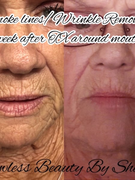 Image of  Cosmetic, Mini Facelift, Minimally Invasive, Neck Tightening, Skin Treatments