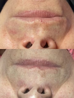 View Facial, Skin Treatments - Yari Santiago, Dracut, MA
