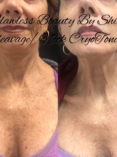 View Cosmetic, Neck Tightening, Minimally Invasive, Mini Facelift, Skin Treatments - Shilo Hope Stanley, La Mesa, CA
