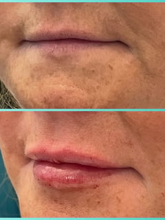 View Forehead, Chin, Minimally Invasive, Neck Tightening, Filler, Lips, Cheeks, Smile Lines, Cosmetic, Skin Treatments, Neurotoxin, Facial, Chemical Peel, Microdermabrasion, Microneedling, LED Acne Therapy, Dermaplaning, PRP Facial, HydraFacial, Upper Face, Eyes, Lower Face, Body Sculpting, Low-Level Laser Therapy, Radio Frequency, Skin Treatments - Jen Phillips-Kiernan, Round Rock, TX