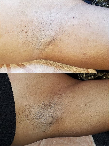 Image of  Underarms , Waxing, Skin Treatments