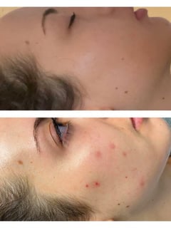 View Skin Treatments, Facial, Chemical Peel, Microdermabrasion, Dermaplaning, HydraFacial, Skin Treatments - Mireille Balian, Waltham, MA