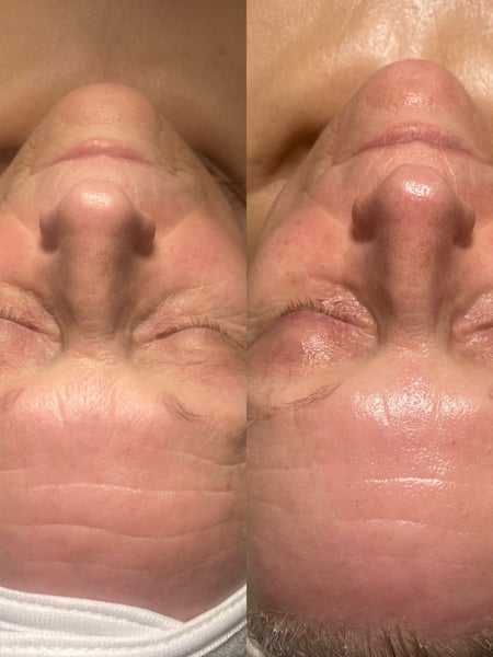Image of  Skin Treatments, Microdermabrasion, Skin Treatments