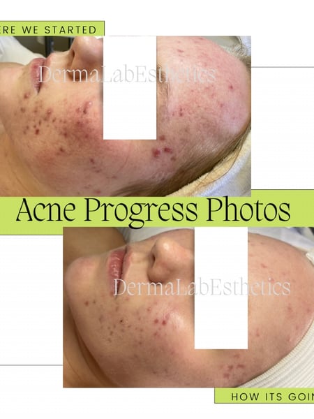 Image of  Skin Treatments, Facial, LED Acne Therapy, Skin Treatments