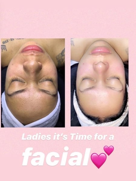 Image of  Cosmetic, Skin, Microdermabrasion, Facial