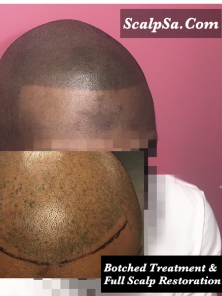 Image of  Cosmetic, Cosmetic Tattoos, Scalp Micropigmentation