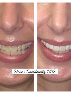 View Dentistry, Porcelain Veneers, Dentistry Services - Dr. Steven Davidowitz, New York, NY