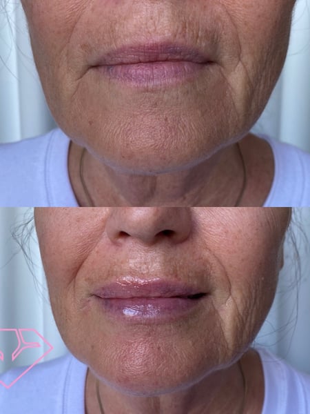 Image of  Chin, Filler, Cosmetic, Lips