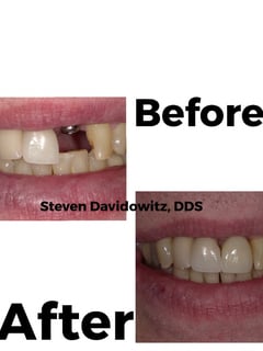 View Dental Crown, Dentistry Services, Dentistry - Dr. Steven Davidowitz, New York, NY