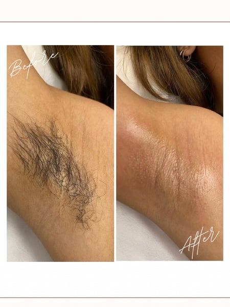 Image of  Waxing, Underarms , Hair Removal