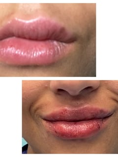 View Lips, Filler, Cosmetic - Tamala Flack, San Antonio, TX