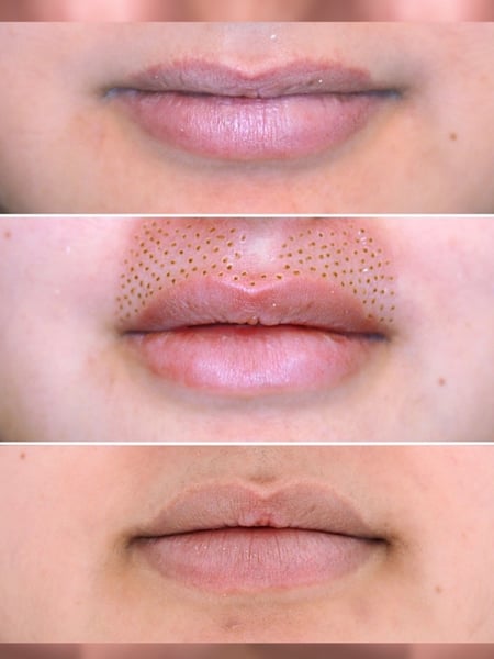 Image of  Cosmetic, Minimally Invasive, Mini Facelift, Neck Tightening, Filler, Lips, Skin Treatments