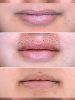 View Cosmetic, Minimally Invasive, Mini Facelift, Neck Tightening, Filler, Lips, Skin Treatments - Jasmine Miller, Broomfield, CO